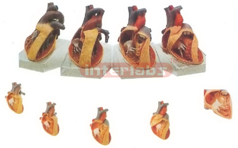 HUMAN COMMON PATHOLOGIES OF CONGENITAL ORGANIC HEART DEFECTS WITH HORIZONTAL BASE